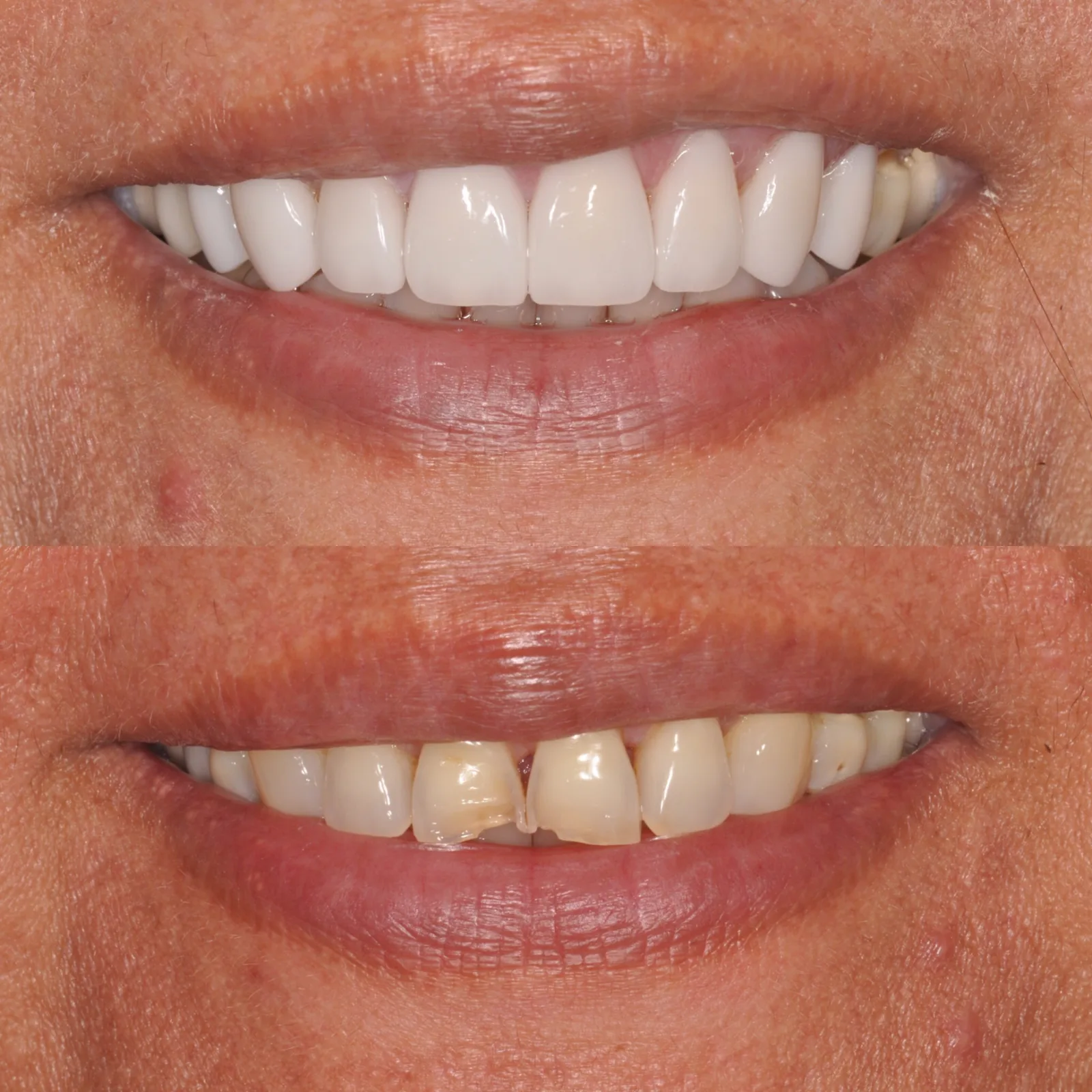 Before-and-after smile transformation case 1