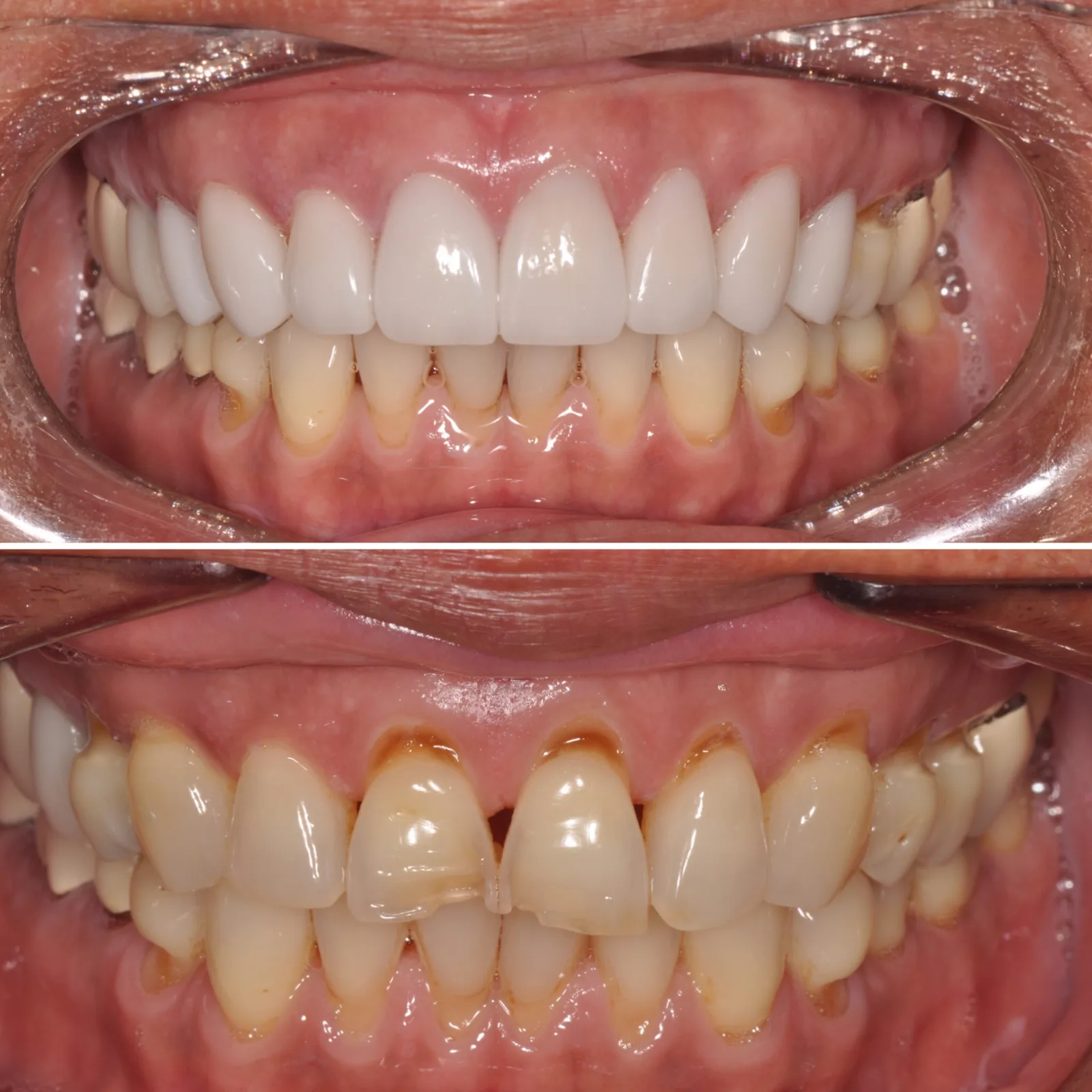 Before-and-after smile transformation case 2