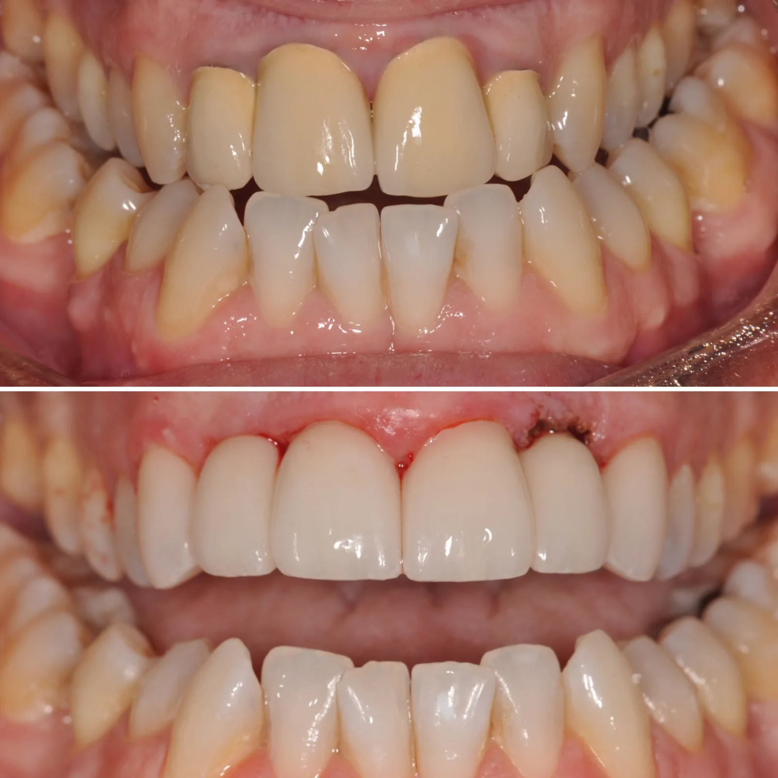 Before-and-after smile transformation case 4