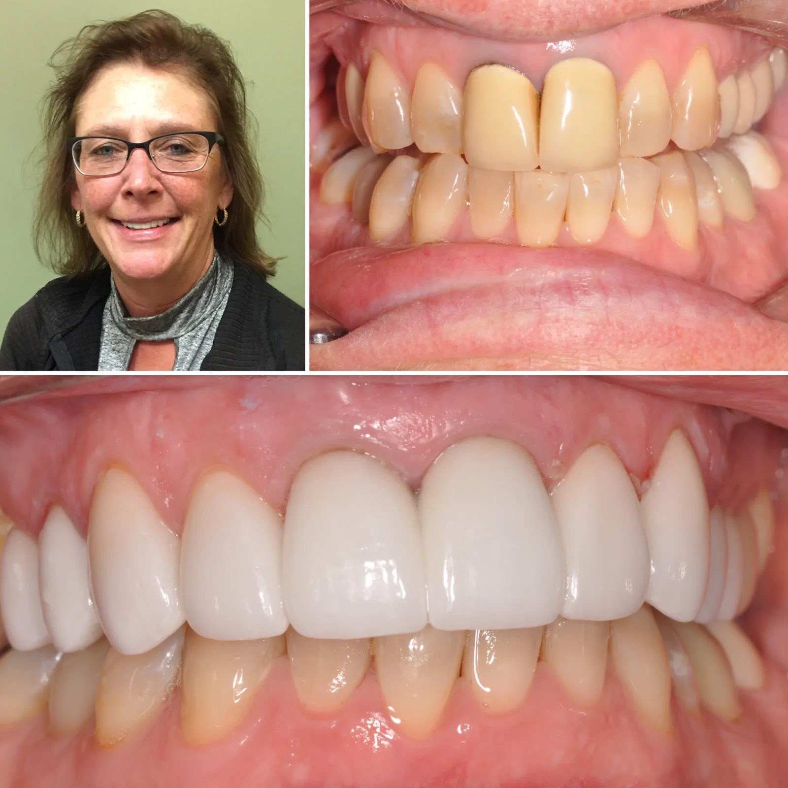 Before-and-after smile transformation case 5